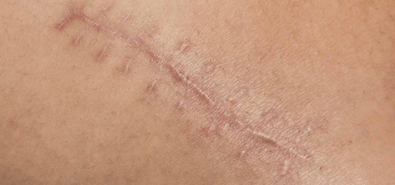 Les effets du tabagisme sur la cicatrisation